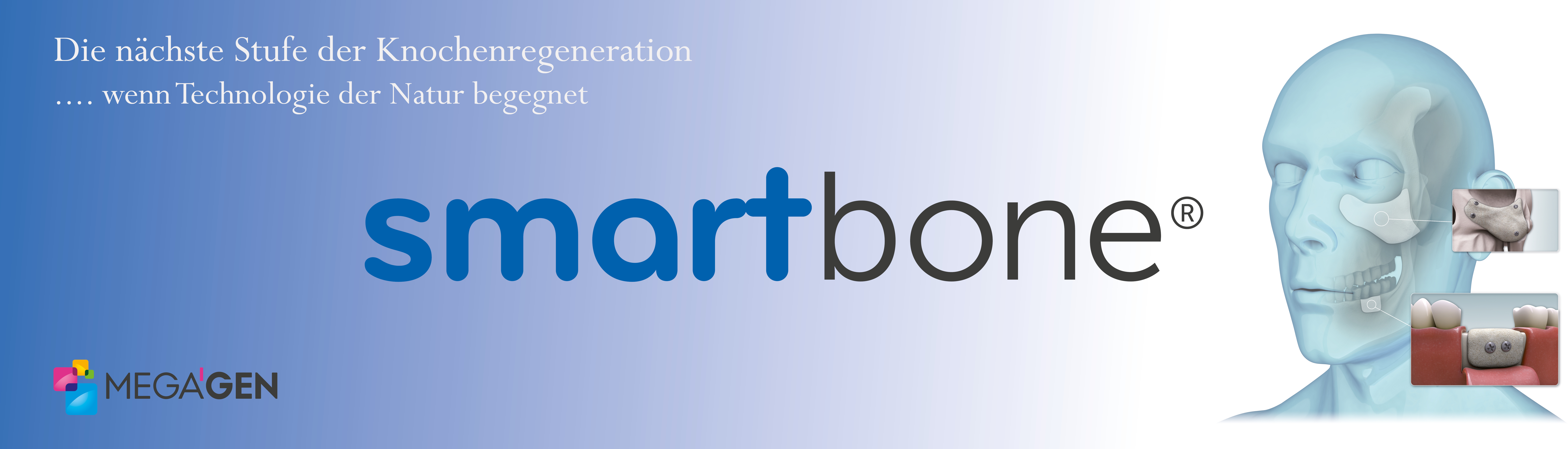 MegaGen präsentiert Smart Bone