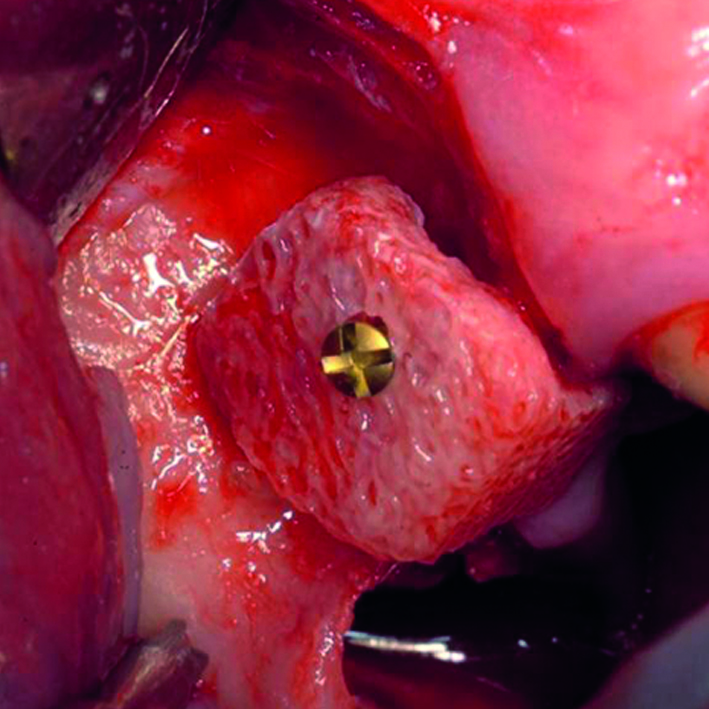 SmartBone biologisch abbaubare Polymere2