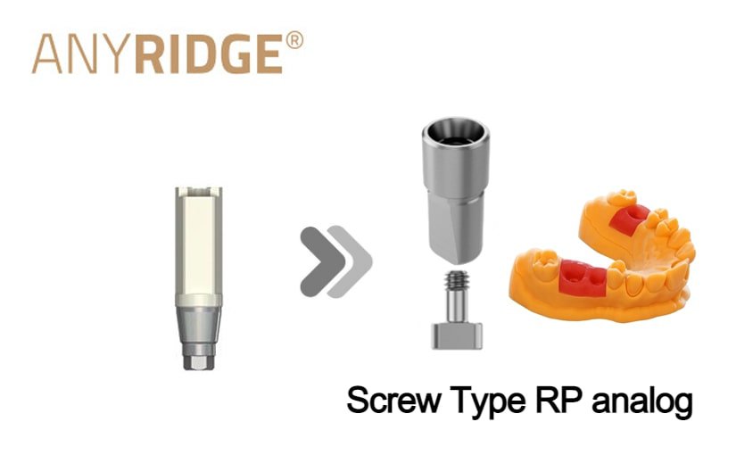 AnyRidge RP_Screw type (3D print model)