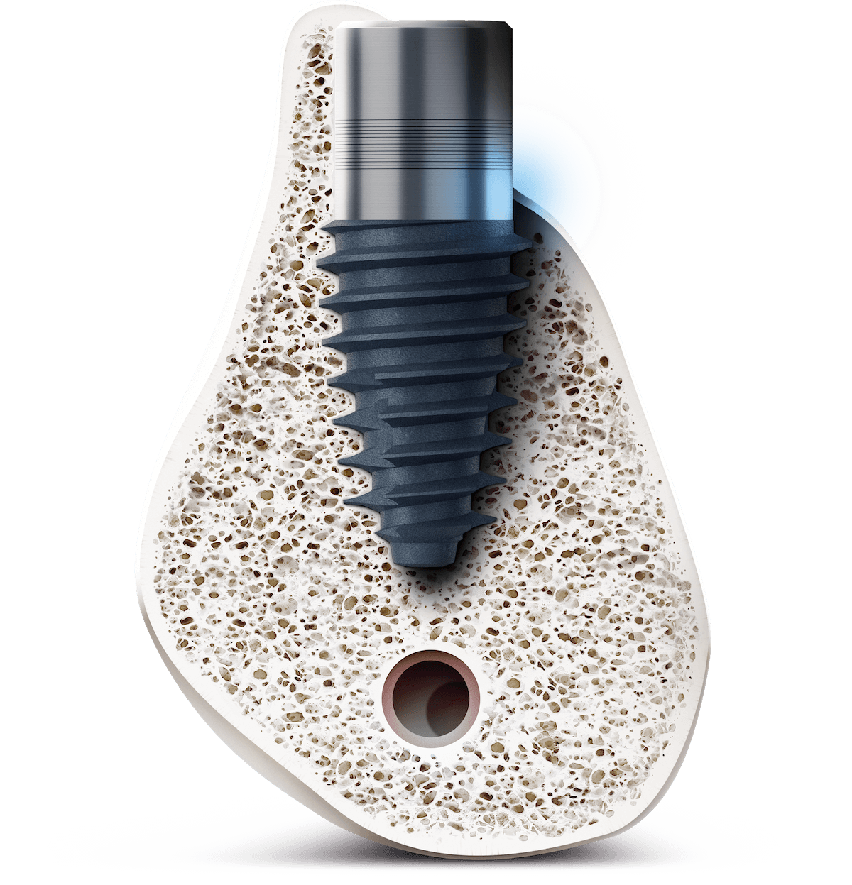 BD Cuff Dental Implantat